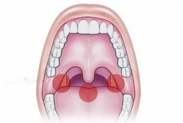 喉嚨容易卡刺位置