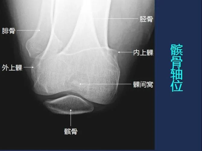 髌骨轴位