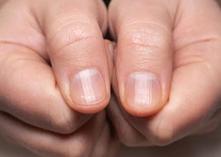 为什么指甲有竖纹？提醒：指甲出现竖纹，和这些原因有关，多留意
